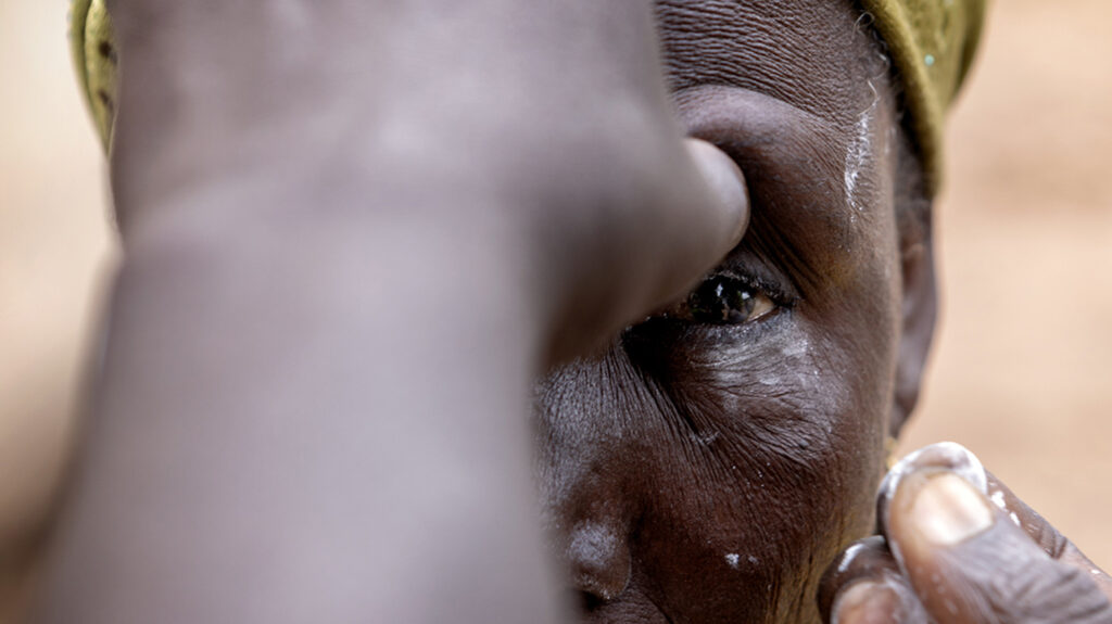 Et nærbilde av en kvinne som får øynene undersøkt for trakom.